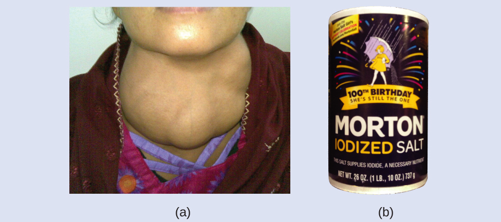 Two pictures. On the left part (a), an image of a woman's neck, showing the enlarged thyroid of a goiter. On the right part (b), a picture of a can of Morton's salt which is prominently advertised as IODIZED.